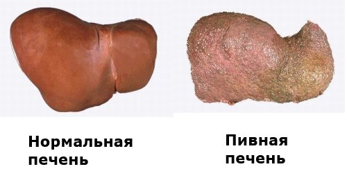 http://zdorovexpert.ru/wp-content/uploads/2013/04/zhirovaya_distrofiya_pecheni_lechenie.jpg